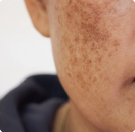 Melasma